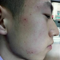 去医院点痣，价格、疼痛感与注意事项全解析