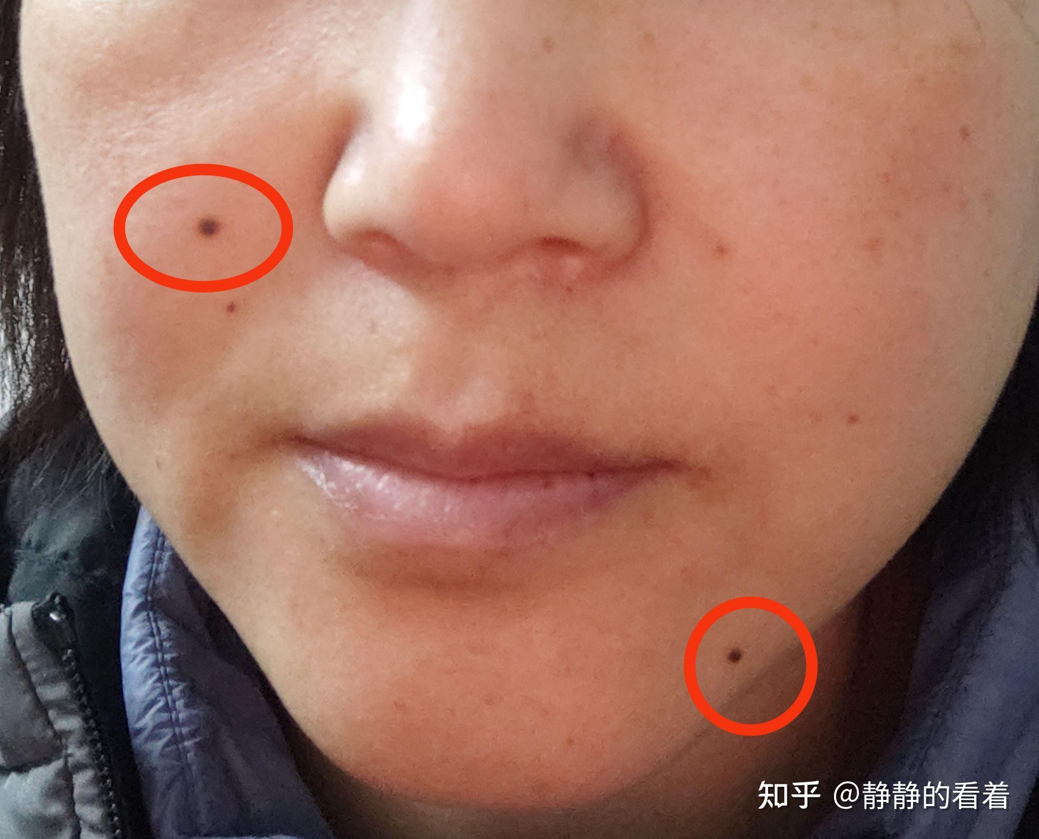 医院点痣，价格、效果与注意事项的全面解析