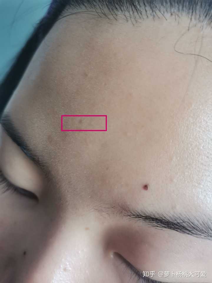 去医院点痣，价格与选择的考量