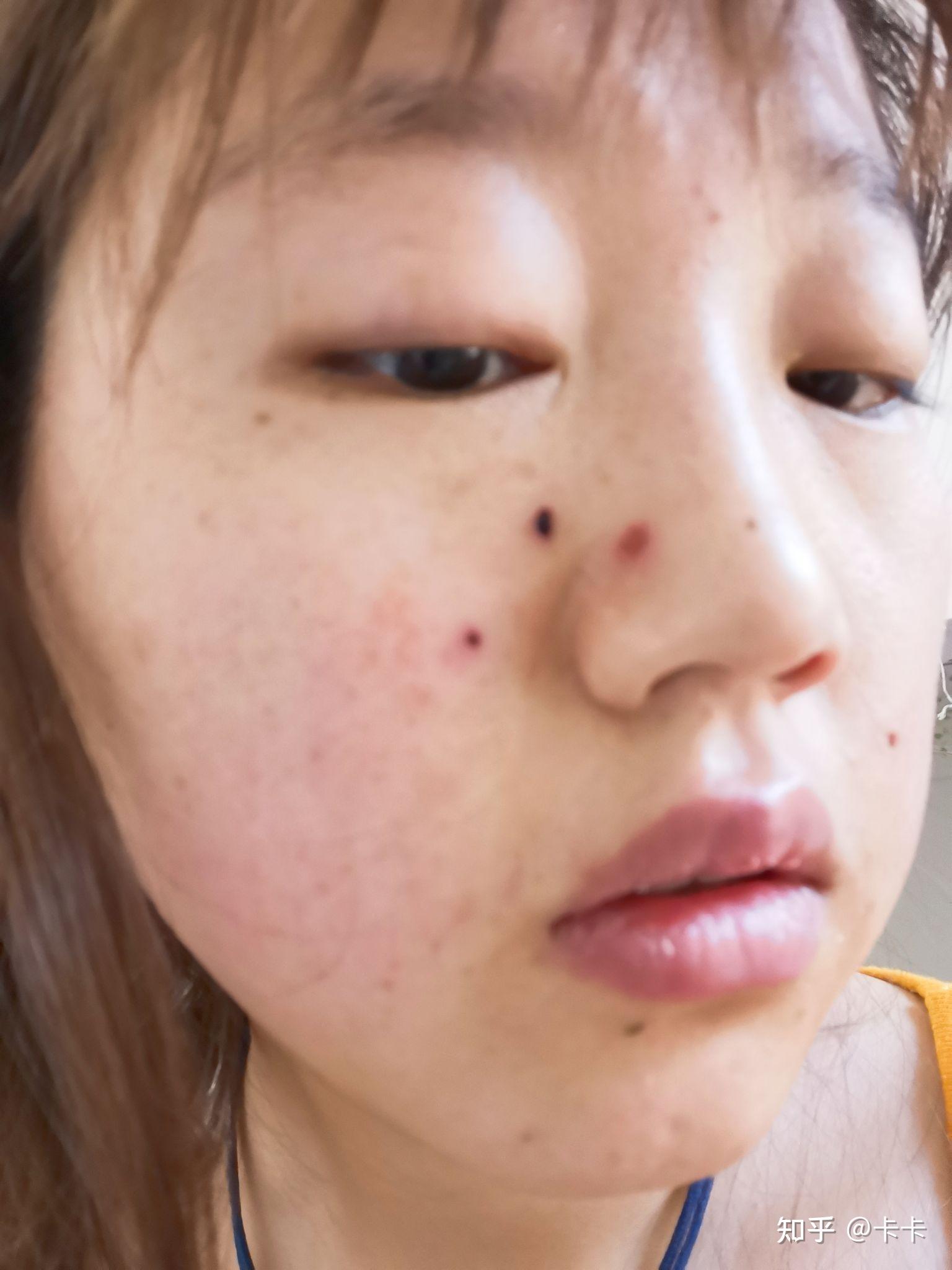 医院点痣价格与治疗周期解析，一次深入探讨