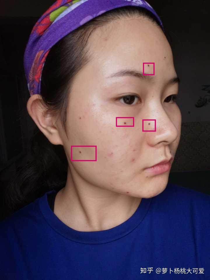 医院点痣价格，全面解析与注意事项