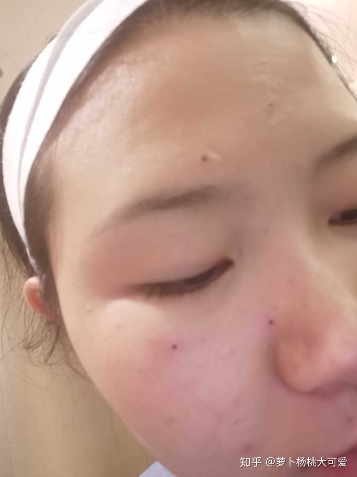 医院点痣价格解析，一颗痣的美丽代价