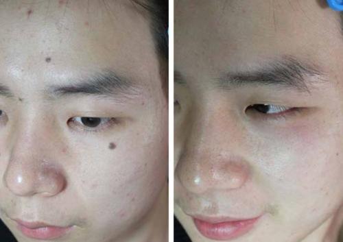 医院点痣价格全解析，安全与性价比的平衡点