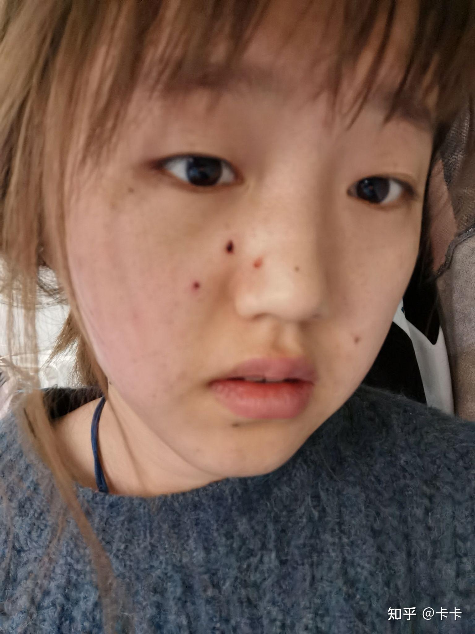 医院点痣价格，合理与透明的选择