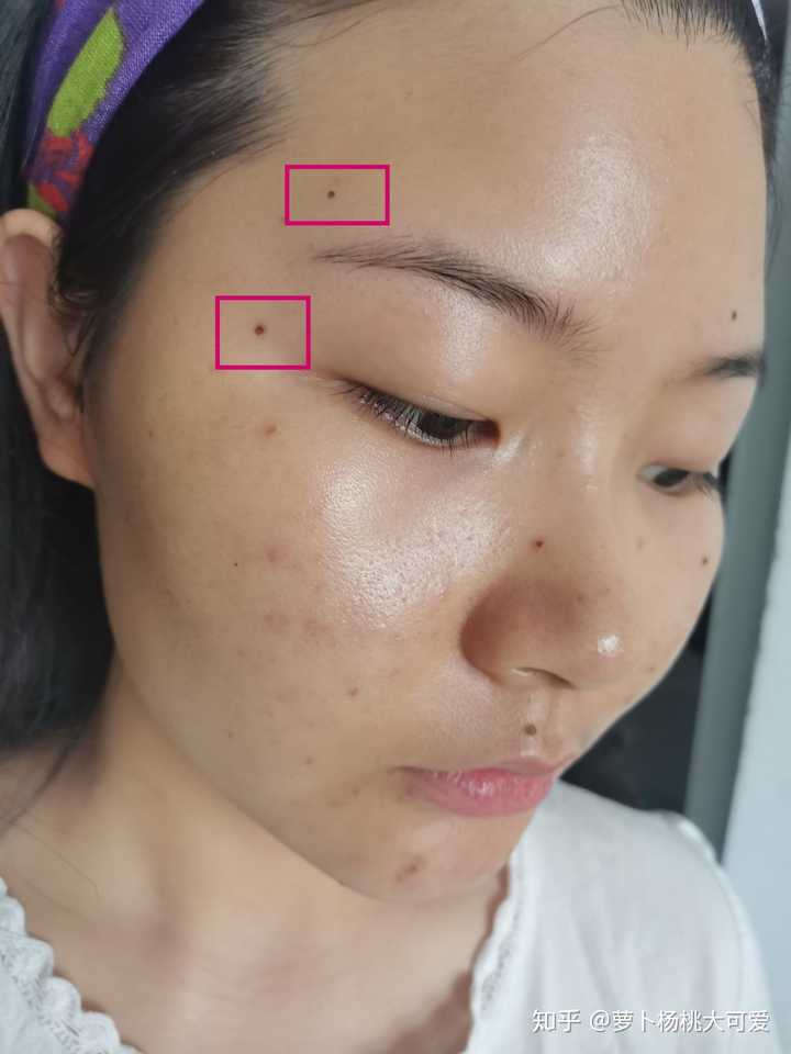 正规医院点痣价格及后续护理全解析
