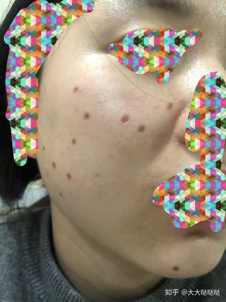 点痣去什么医院比较好，选择与注意事项的全面解析