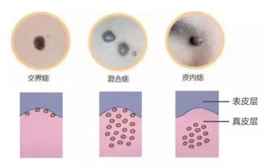点痣去医院的价码，一次了解的全面指南