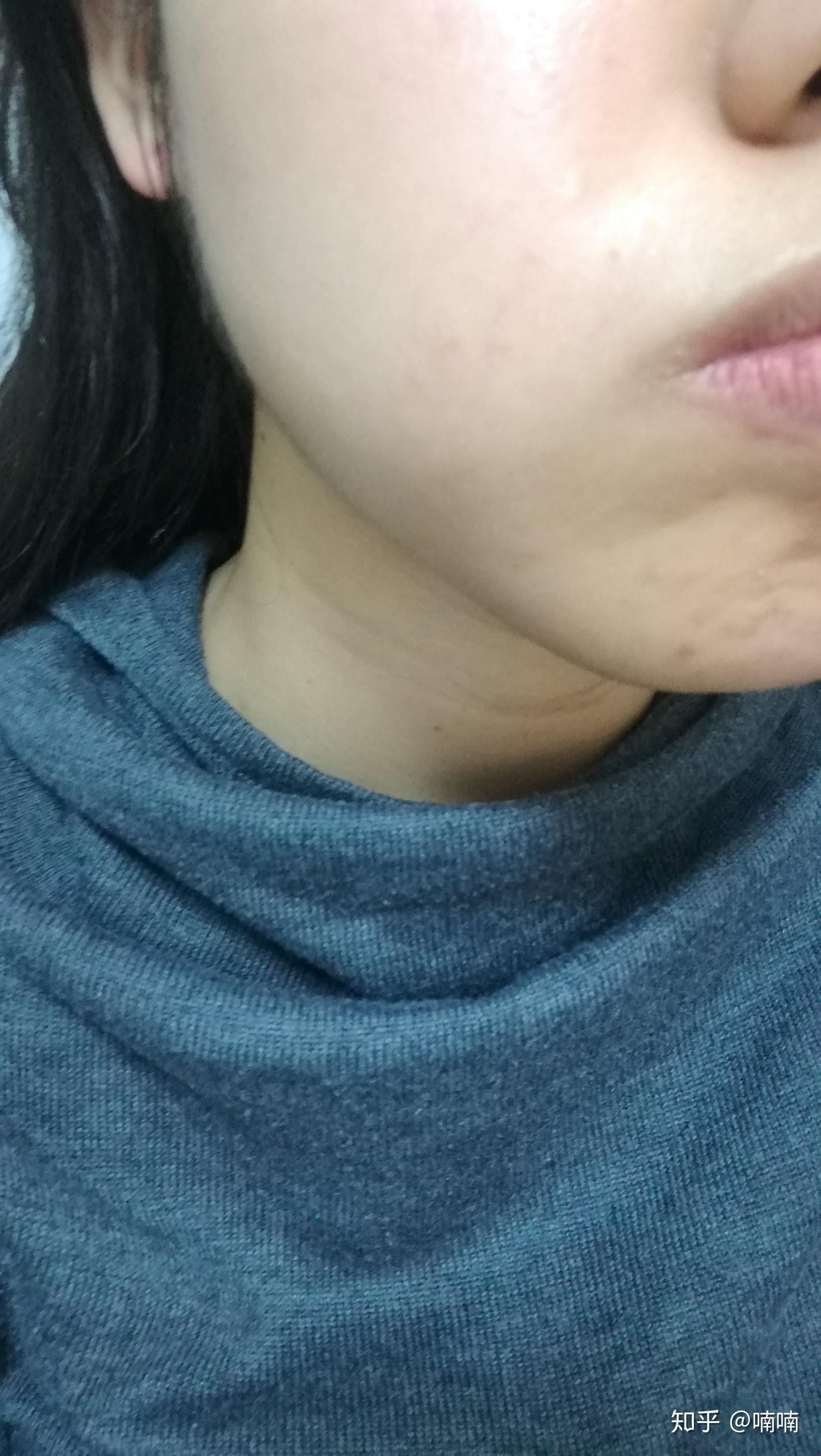 点痣去医院的合理费用与最佳选择