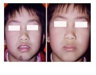 点痣去医院的合理费用，价格与价值的平衡