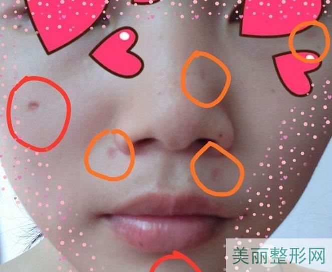 医院皮肤科点痣，价格、效果与注意事项