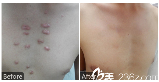 医院皮肤科点痣价格解析，一次治疗的费用与价值考量