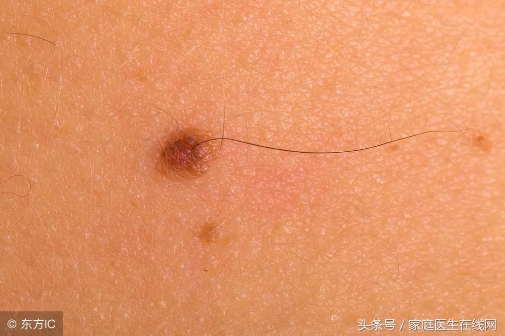 医院皮肤科点痣价格指南，全面解析与注意事项