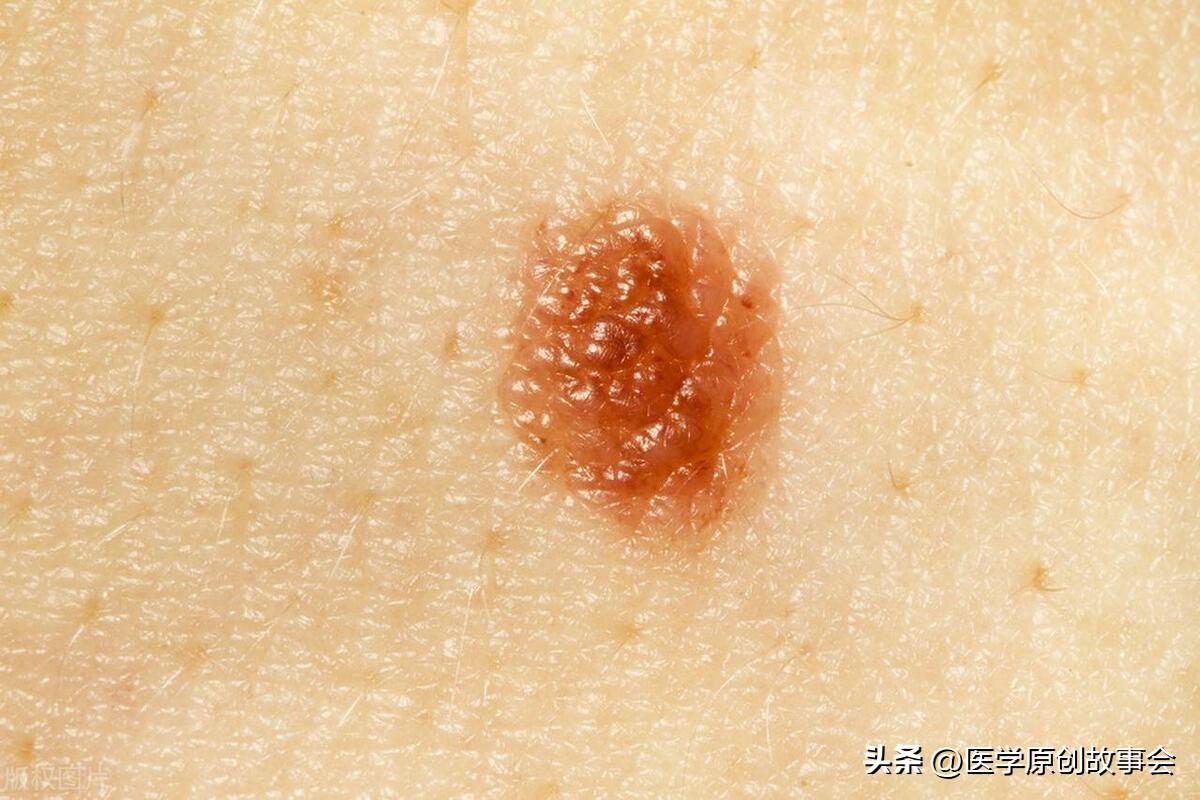 点痣，医院就诊的科室选择与注意事项
