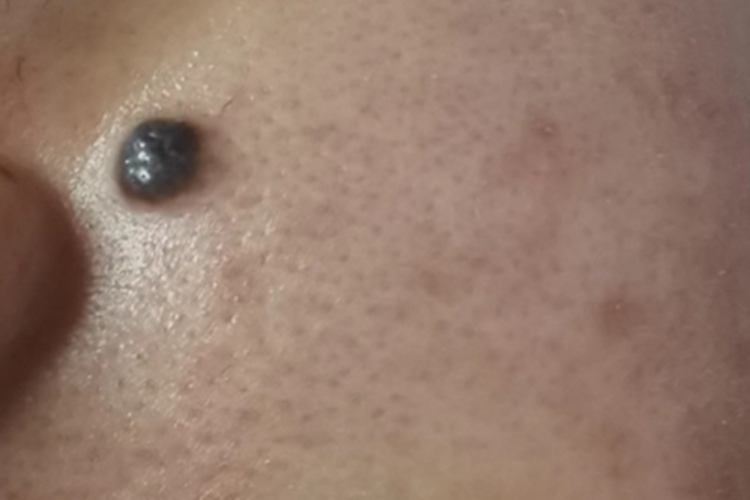 去医院看痣是否病变，挂什么科？
