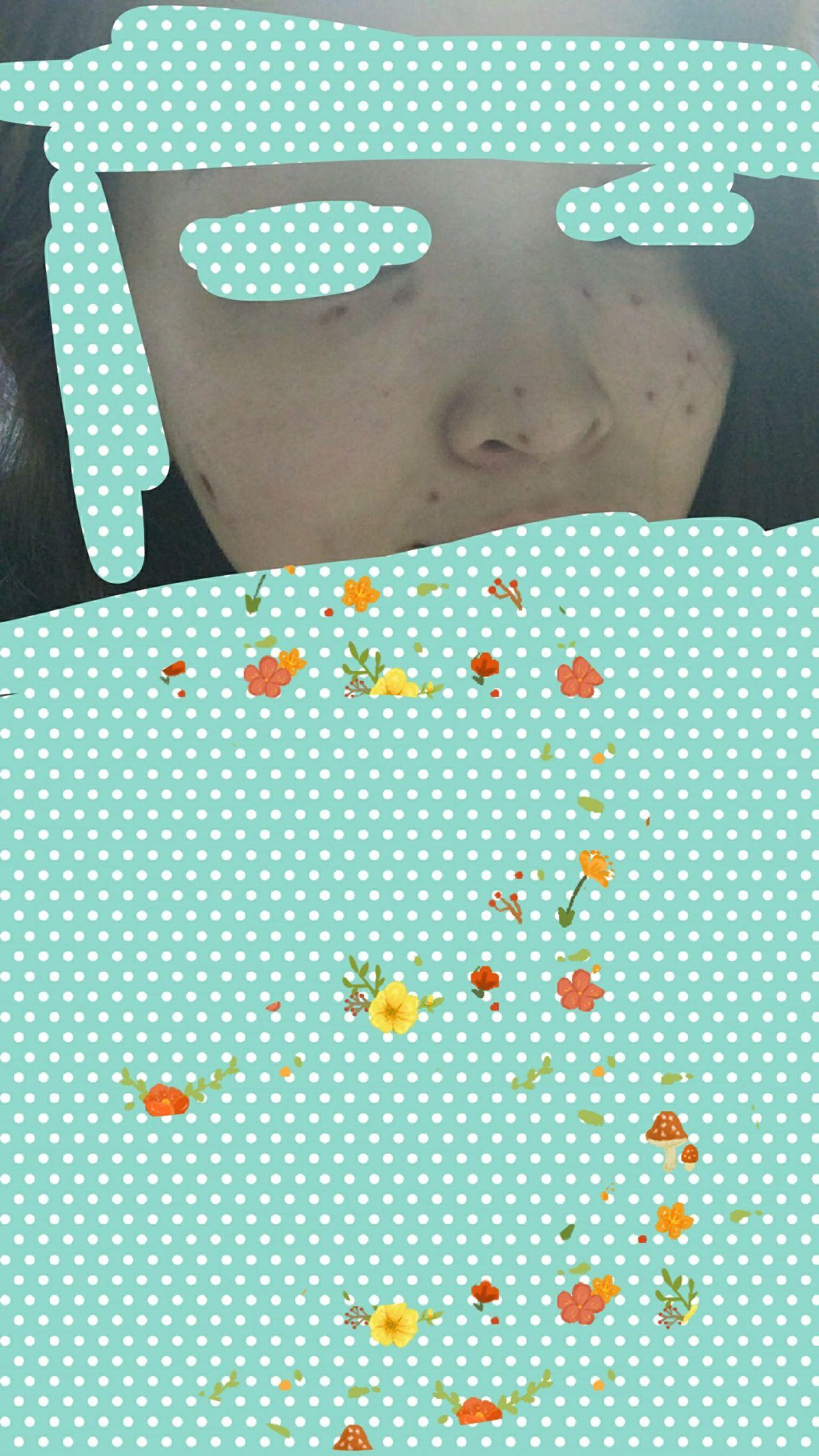 点痣，医院挂号的正确选择与注意事项