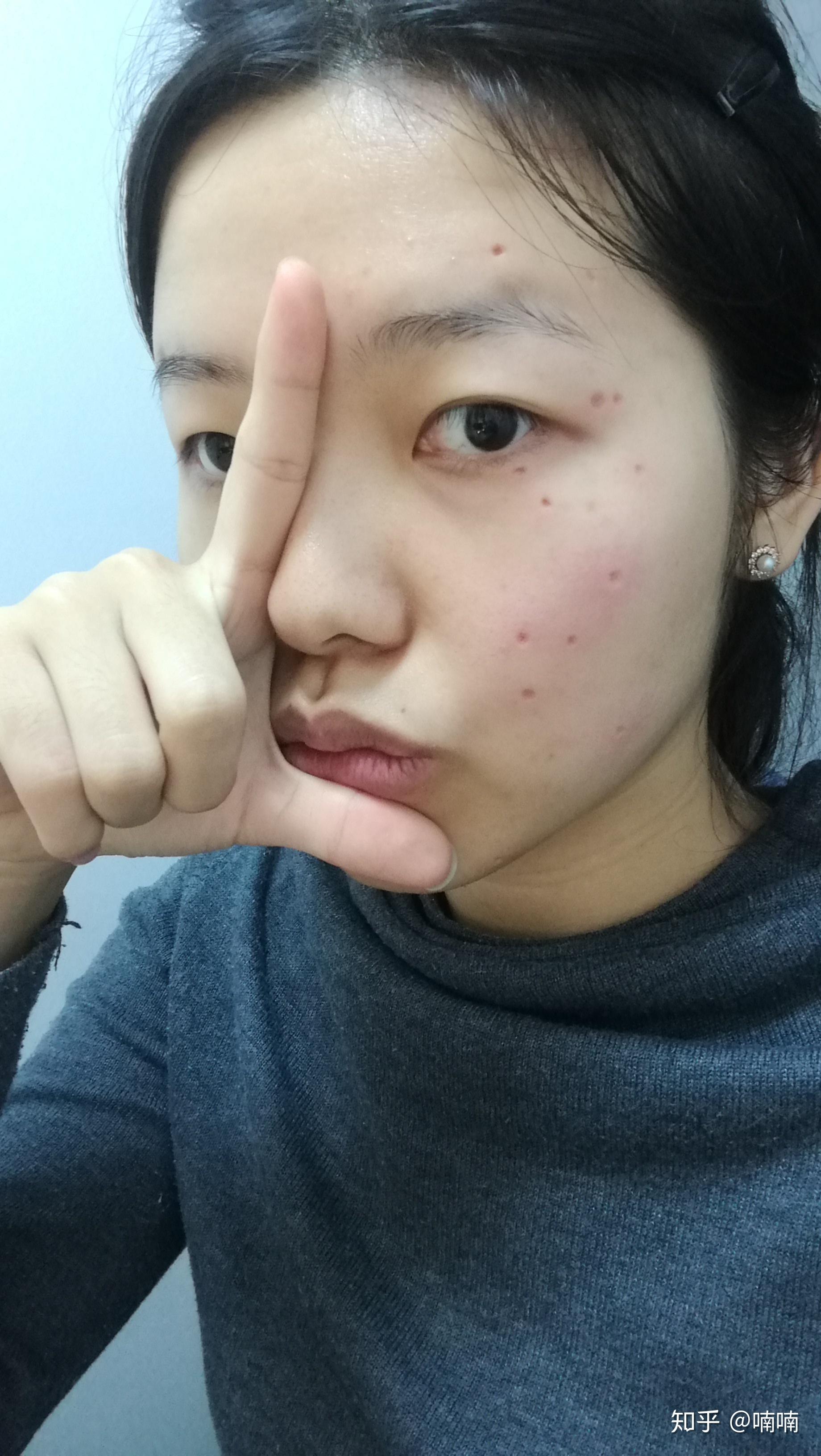 点痣，该去医院挂什么科室？