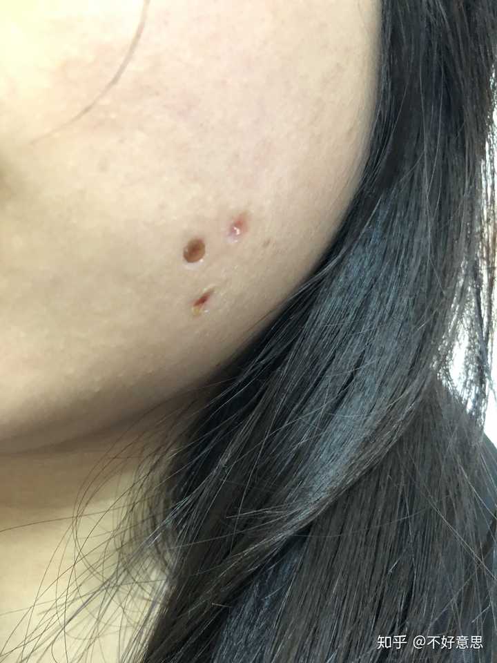 点痣应去医院哪个科？——专业指南与注意事项