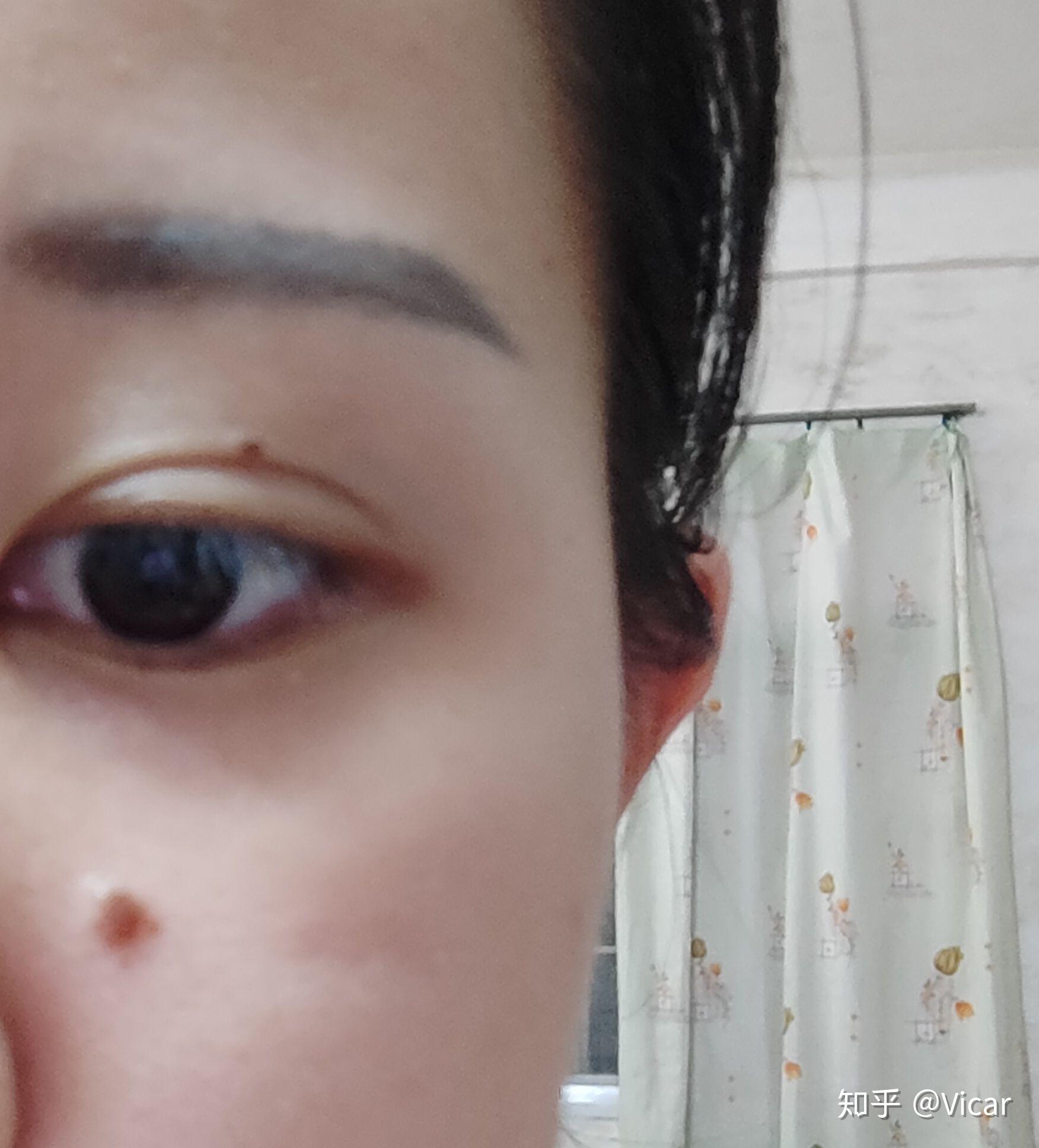 公立医院可以点痣吗？——专业服务与安全保障的双重考量