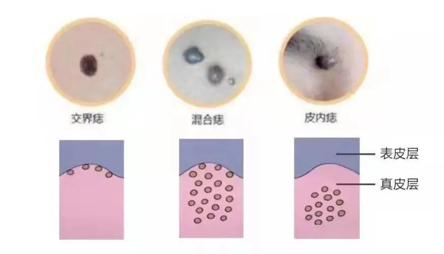 医院点痣挂什么科室？——全面解析与实用指南