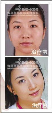 医院激光祛痣，价格、效果与注意事项的全面解析