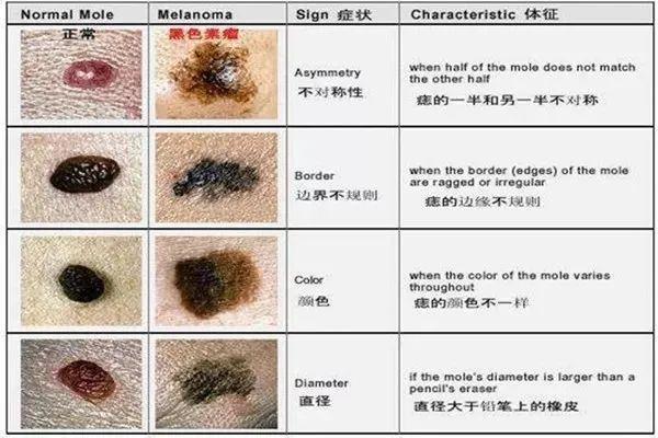 西青医院祛痣价格解析，全面了解费用构成与注意事项