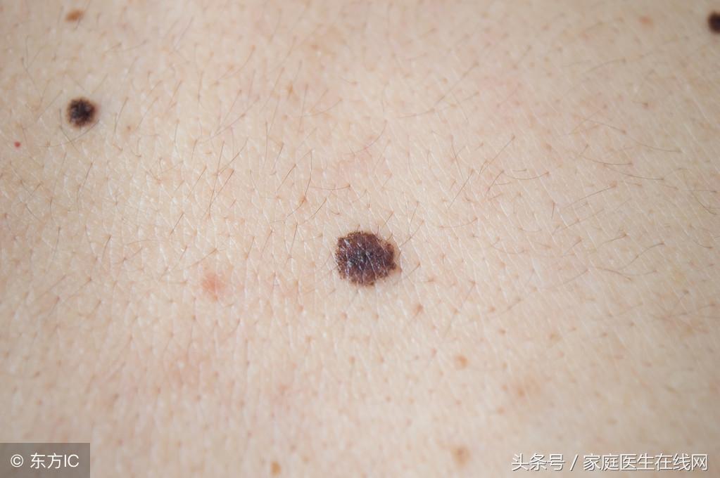 医院祛痣服务价格解析，全面了解与合理预期