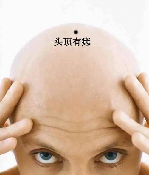 深圳龙华区医院点痣价格解析，安全与美观的平衡艺术