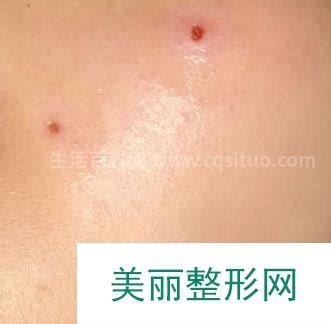 医院取痣，价格与价值的考量