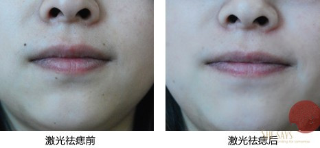 医院去痣的价格，影响因素与费用解析