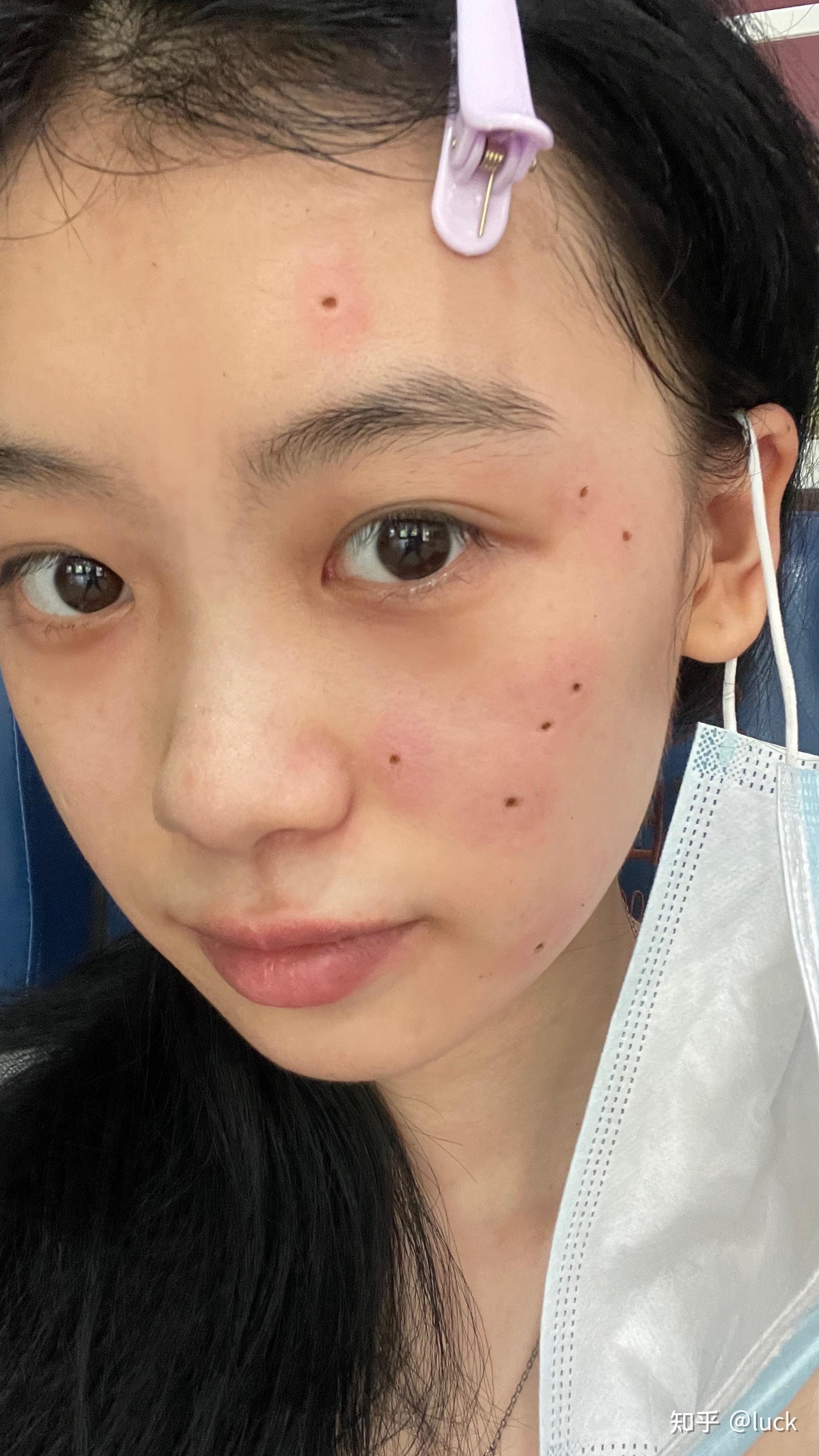 去医院点痣的详细流程指南