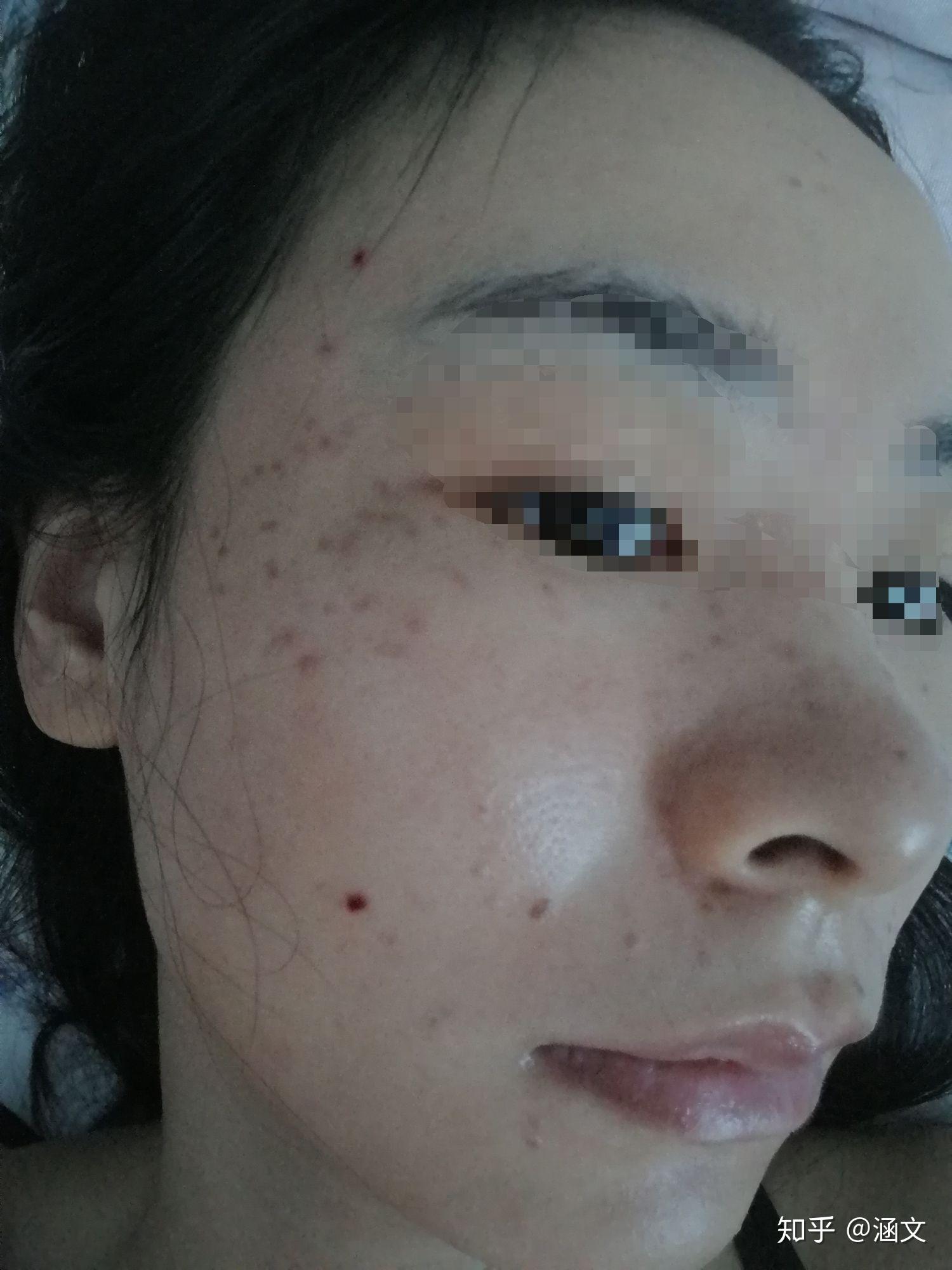 去医院点痣的全面指南，从预约到恢复的完整流程