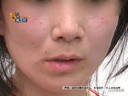 点痣，医院与美容整形医院的优劣比较