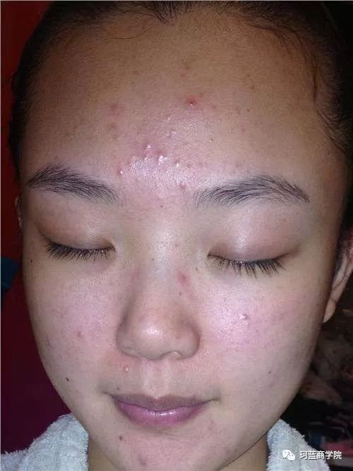 脸上点痣，医院VS美容院的抉择