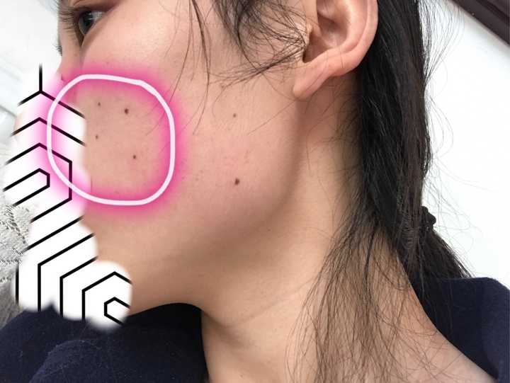 点痣，医院与美容院的抉择——安全与效果的全面解析