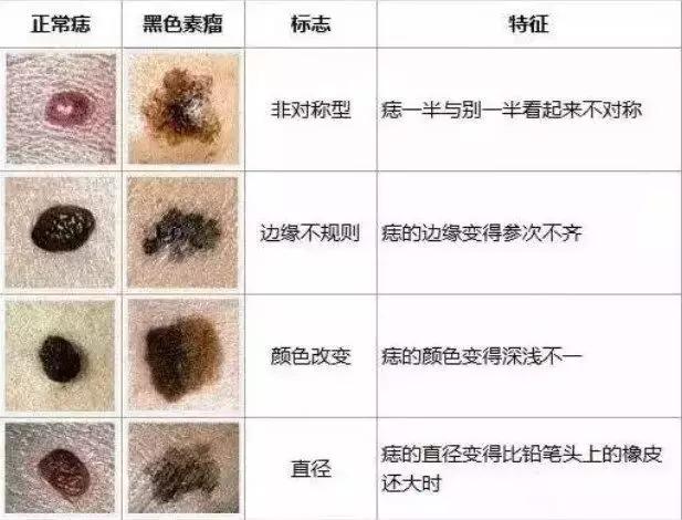 医院点痣的收费标准与影响因素解析