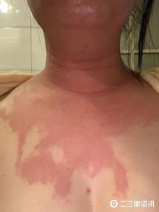 探秘三甲医院点痣，安全、专业与美丽的完美结合