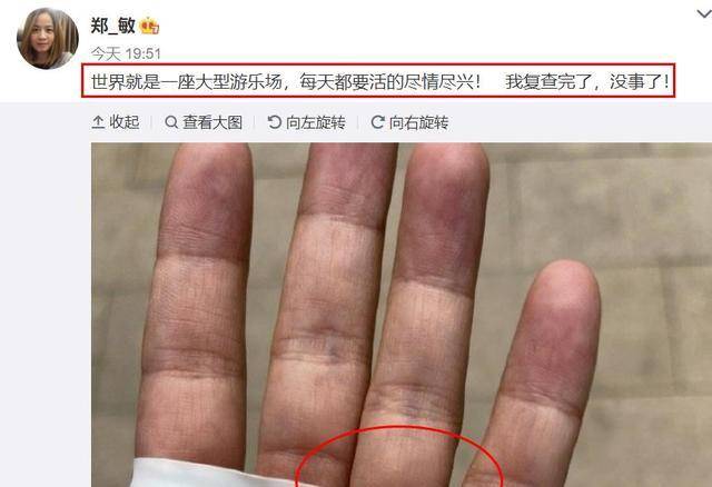 正规医院点痣手术费用解析，安全与性价比的平衡考量