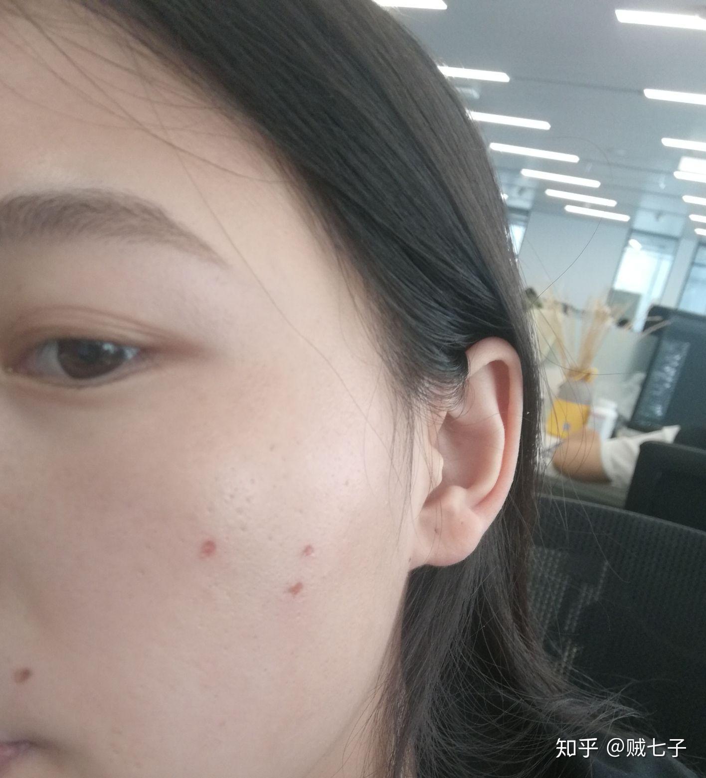 上海点痣，选择专业医院，守护美丽肌肤
