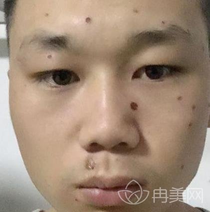 点痣去医院的费用解析，一颗痣的价格标签