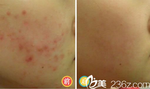 点痣去医院，价格与价值的明智考量