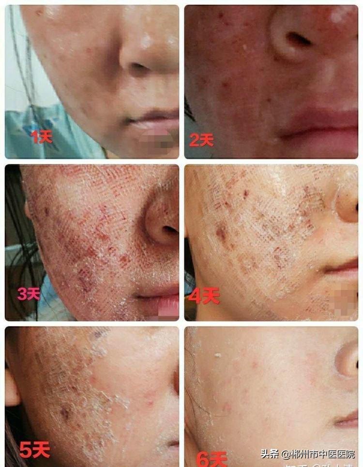 医院激光去疣，价格与价值的考量
