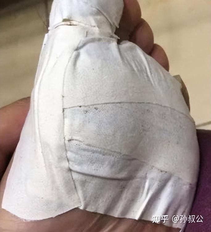 医院激光治疗疣的费用解析