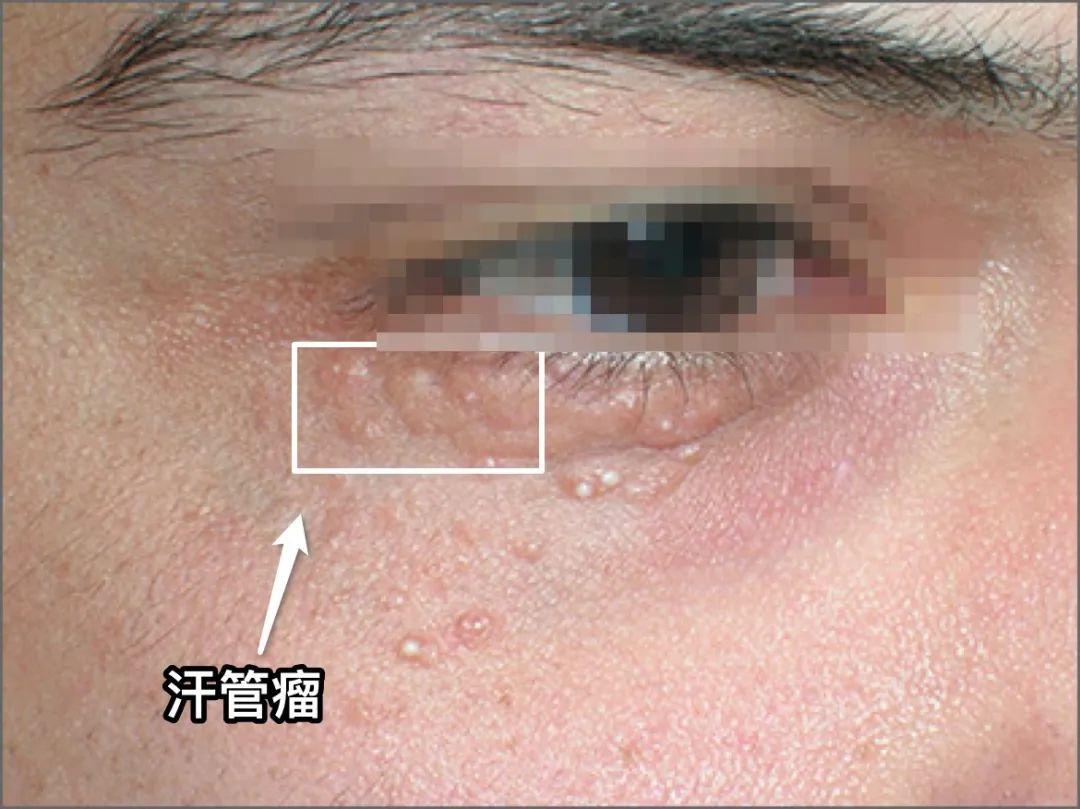 深圳三甲医院激光去疣费用解析，全面了解与注意事项