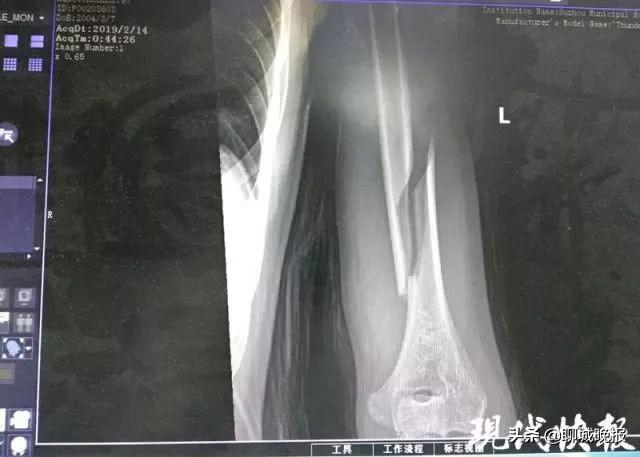 医院骨头照片（X光）价格解析，全面了解与注意事项
