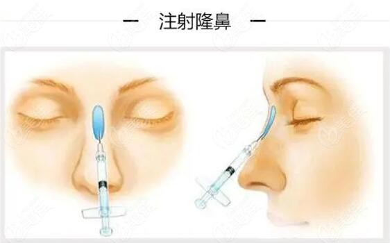 最好的隆鼻医院是哪家？——全面解析与选择指南