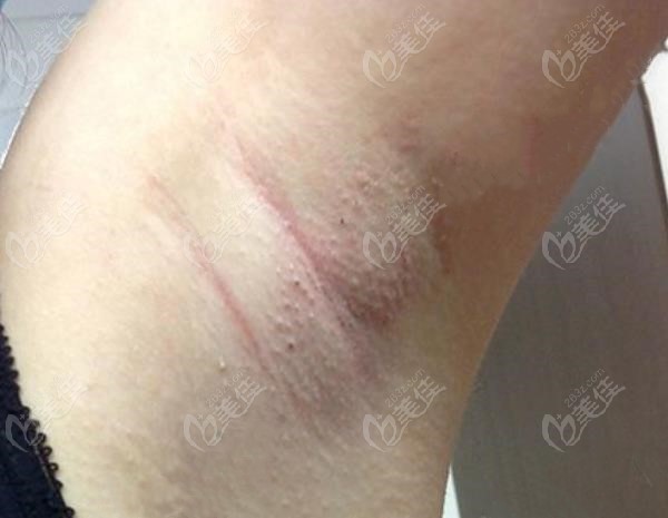 昆明腋臭手术医院排名，选择专业与信赖的医疗之选