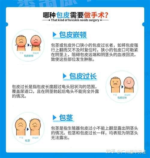 昆山割包皮，选择优质医院的关键因素与指南